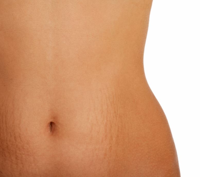 растяжки после родов