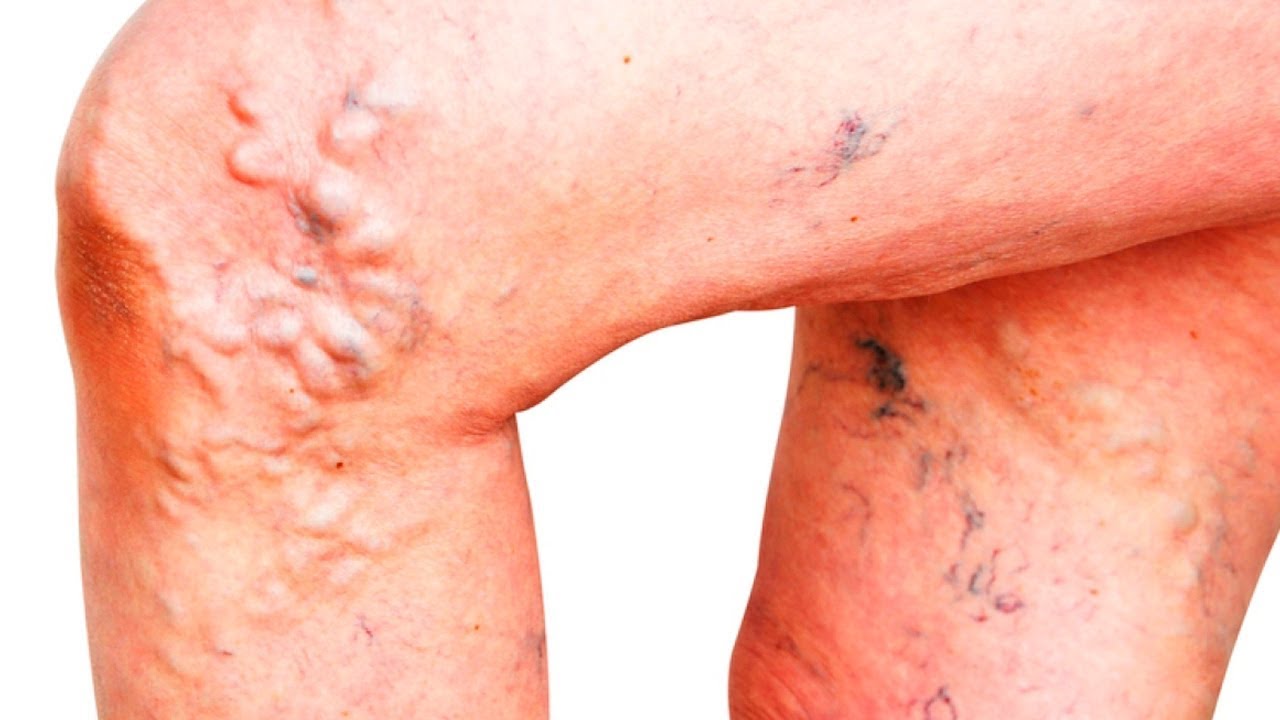 Варикозная болезнь: советы на каждый день